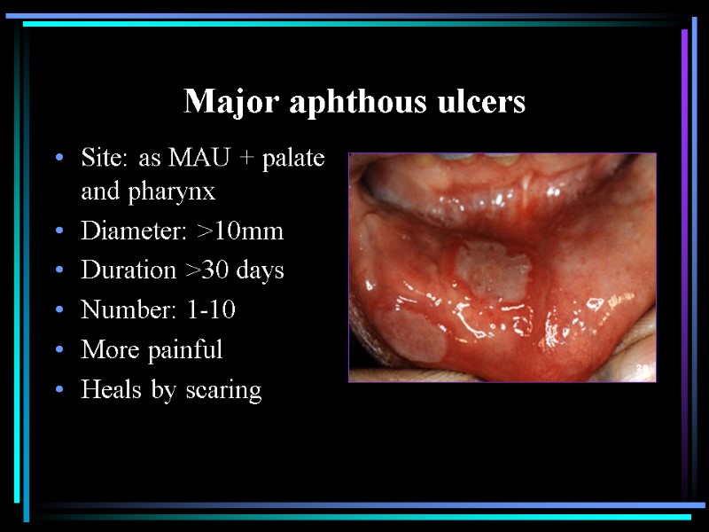 Major aphthous ulcers Site: as MAU + palate and pharynx Diameter: >10mm Duration >30